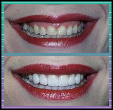 Bradlee Dental Care - worn, discolored teeth