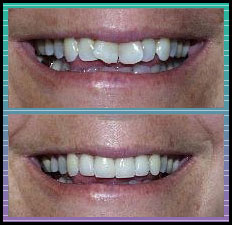 Bradlee Dental Care - crooked teeth