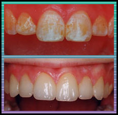 Bradlee Dental Care - splotchy teeth