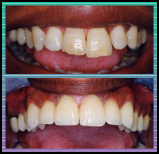 Bradlee Dental Care - dark, misshapen teeth