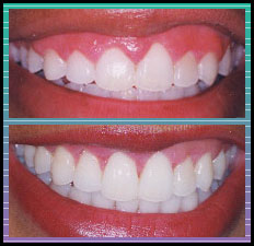 Bradlee Dental Care - gummy smile