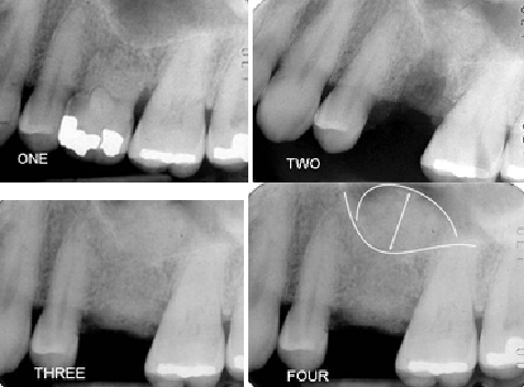Maxillary Sinus Lift Techniques for Dental Implants